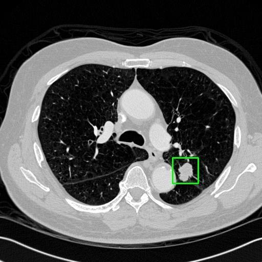 LUNG CANCER DETECTION AND ANALAYSIS WITH AI  – screenshot 67
