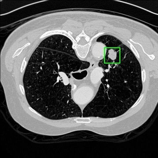 LUNG CANCER DETECTION AND ANALAYSIS WITH AI  – screenshot 68