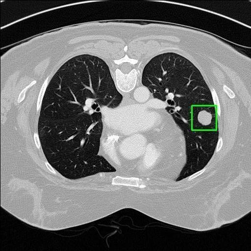 LUNG CANCER DETECTION AND ANALAYSIS WITH AI  – screenshot 69