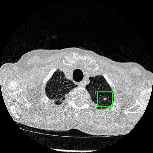 LUNG CANCER DETECTION AND ANALAYSIS WITH AI  – screenshot 70