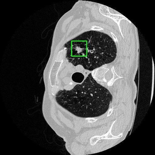LUNG CANCER DETECTION AND ANALAYSIS WITH AI  – screenshot 72