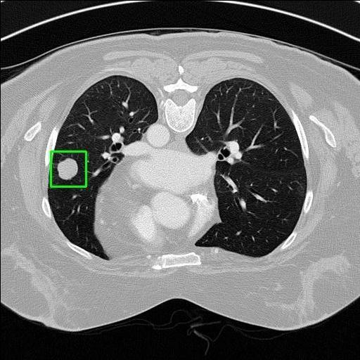 LUNG CANCER DETECTION AND ANALAYSIS WITH AI  – screenshot 73