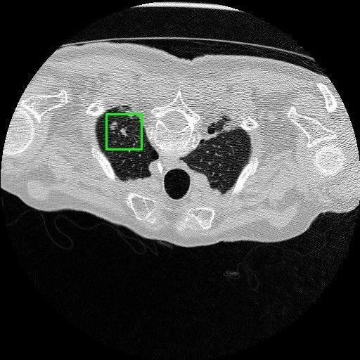 LUNG CANCER DETECTION AND ANALAYSIS WITH AI  – screenshot 74