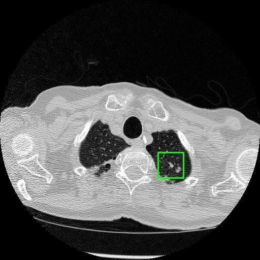 LUNG CANCER DETECTION AND ANALAYSIS WITH AI  – screenshot 75