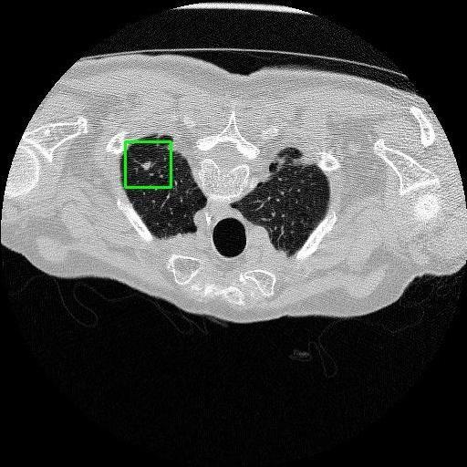 LUNG CANCER DETECTION AND ANALAYSIS WITH AI  – screenshot 76