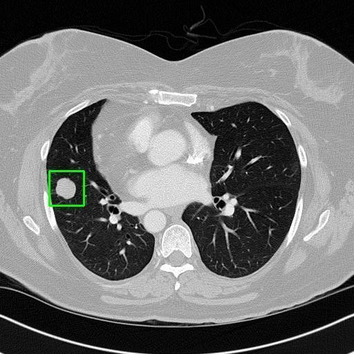 LUNG CANCER DETECTION AND ANALAYSIS WITH AI  – screenshot 77