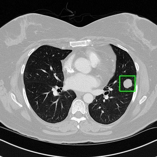 LUNG CANCER DETECTION AND ANALAYSIS WITH AI  – screenshot 79