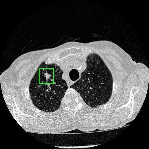 LUNG CANCER DETECTION AND ANALAYSIS WITH AI  – screenshot 80