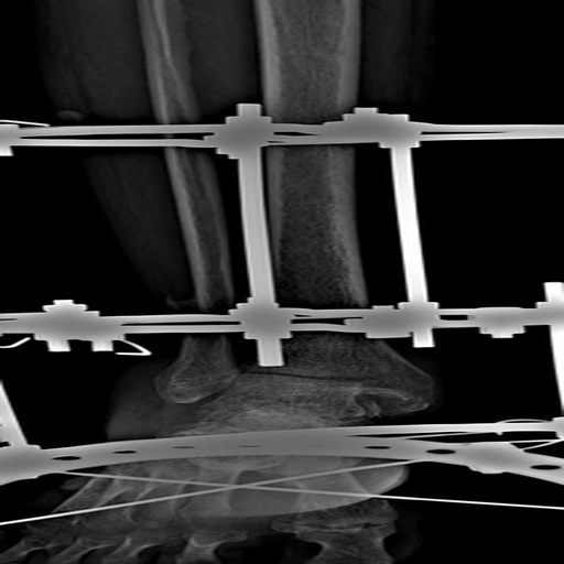 OsteNet: A Novel Tool For Hairline Fractures In Bone Disease – screenshot 2