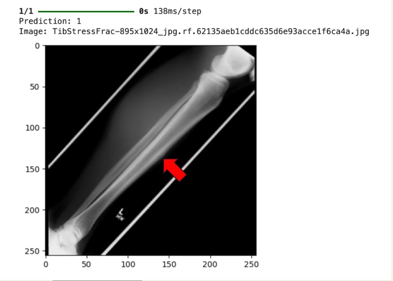 OsteNet: A Novel Tool For Hairline Fractures In Bone Disease – screenshot 6
