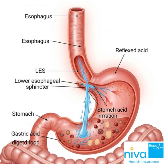 Gastroesophageal Reflux Disease (GERD) – screenshot 1