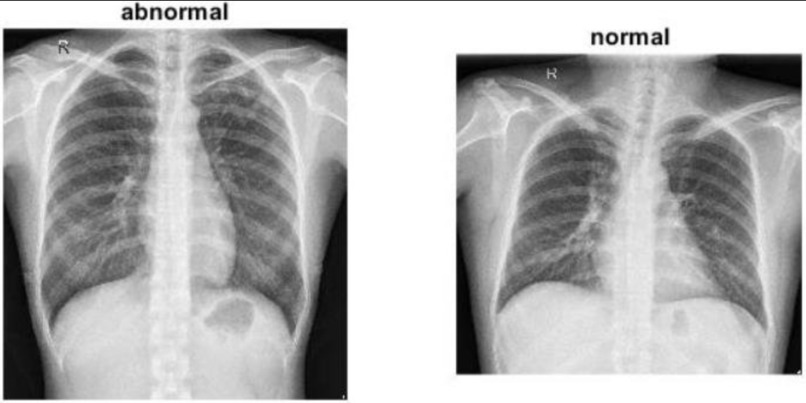 Chest-X-Ray-Medical-Diagnosis-with-Deep-Learning – screenshot 1