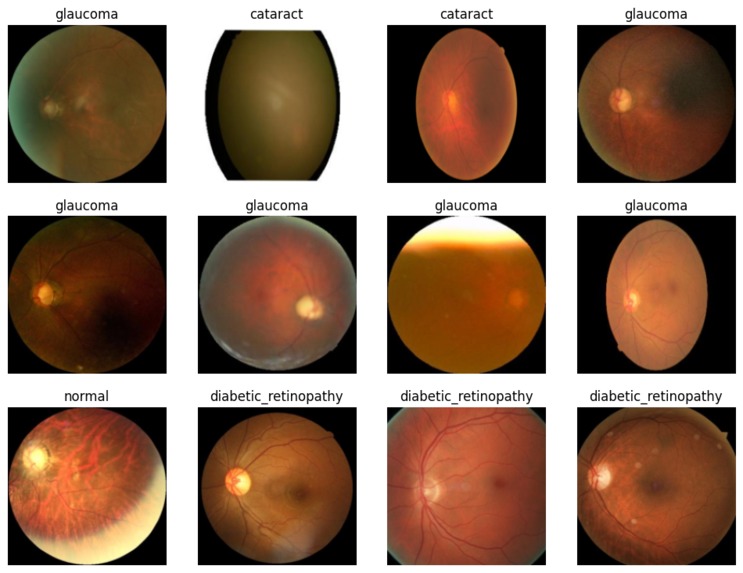 Eye Disease Detection Model – screenshot 1