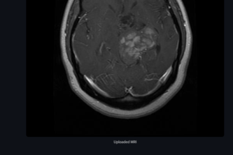 Tumor-AI-D:  AI Model for Multiclass Brain Tumor Diagnosis