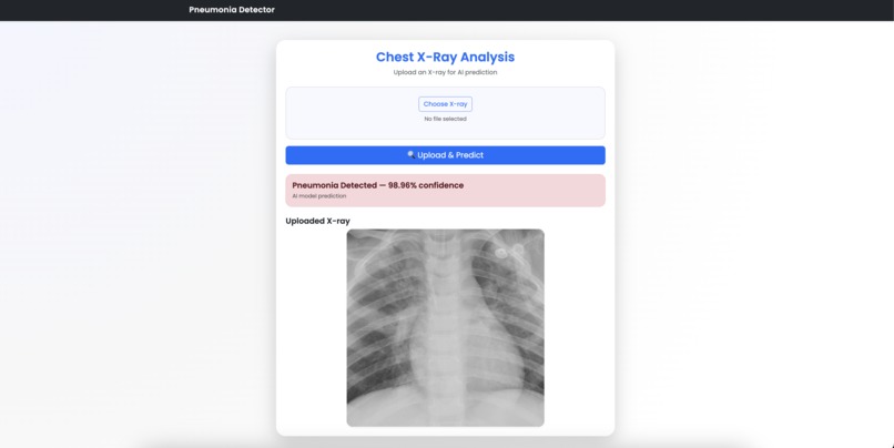 Pneumonia X-Ray Detector – screenshot 1