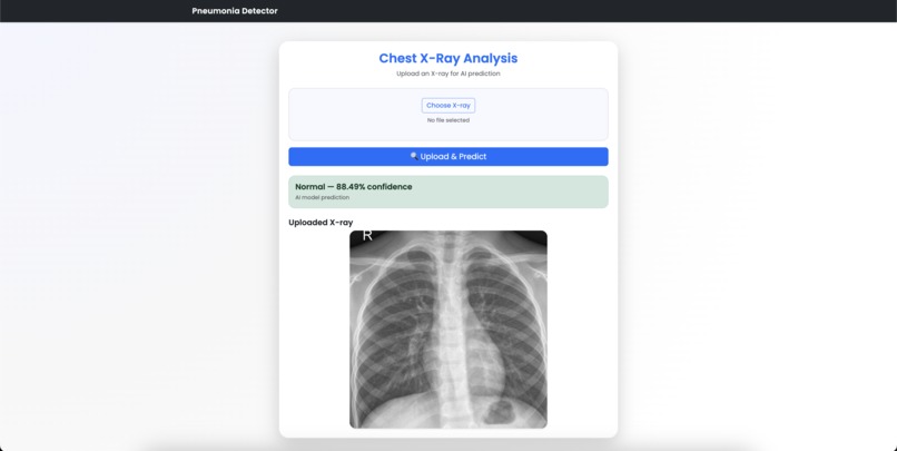 Pneumonia X-Ray Detector – screenshot 3