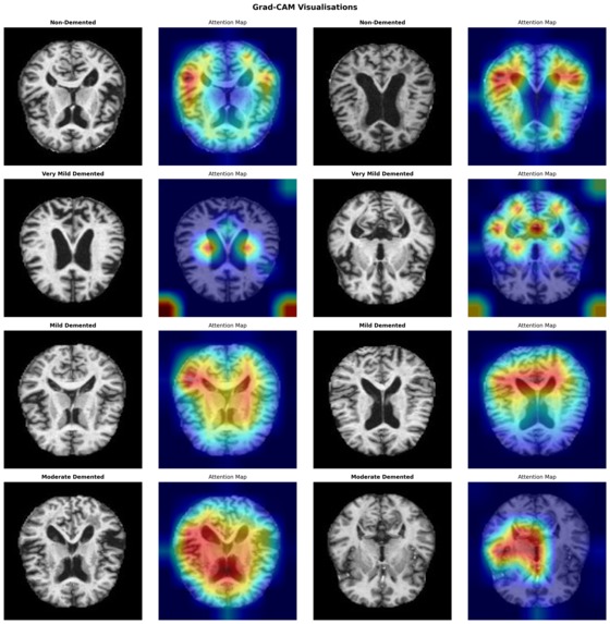Deep Learning AI for Early MRI-Based Alzheimer’s Detection – screenshot 1