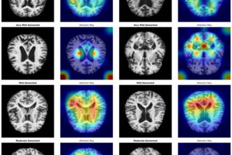 Deep Learning AI for Early MRI-Based Alzheimer’s Detection