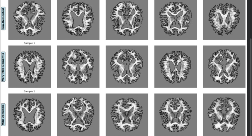 NeuroXAI: Advanced Explainable Alzheimer's Detection System – screenshot 9