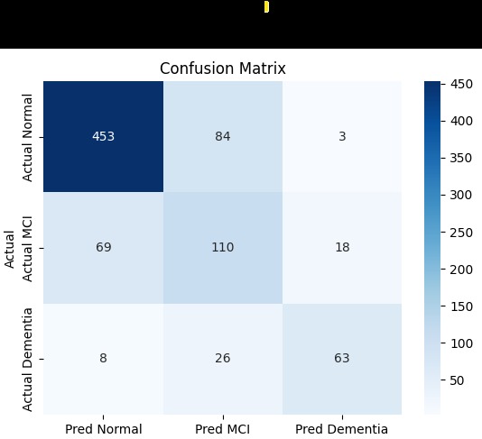 Multimodal AI for Early Detection of Alzheimer’s Disease – screenshot 1