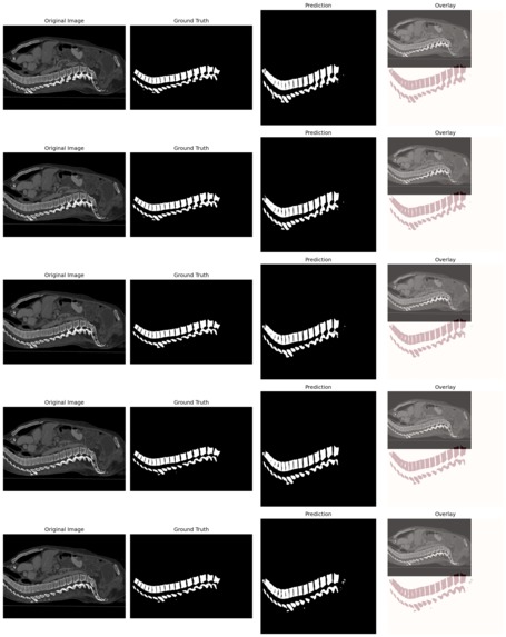 2-D Spinal Segmentation & Fracture Detection – screenshot 1
