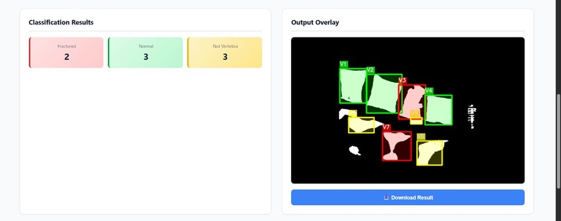 2-D Spinal Segmentation & Fracture Detection – screenshot 2