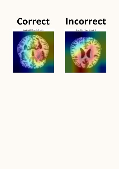 Explainable AI for Alzheimer’s Disease MRI Classification – screenshot 1