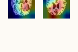 Explainable AI for Alzheimer’s Disease MRI Classification