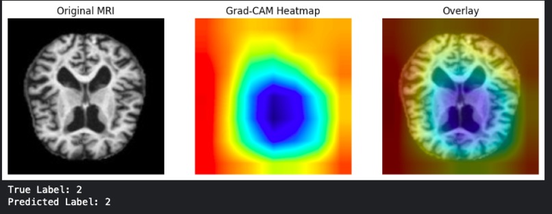 Explainable Alzheimer’s Detection from MRI Using ResNet – screenshot 1