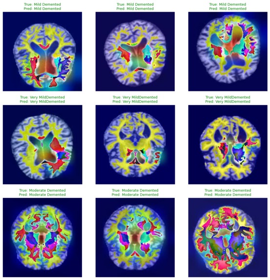 Alzheimer_MRI – screenshot 3