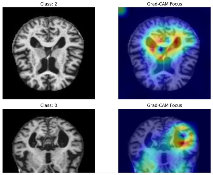 NeuroSense: AI for Alzheimer’s Diagnosis – screenshot 3