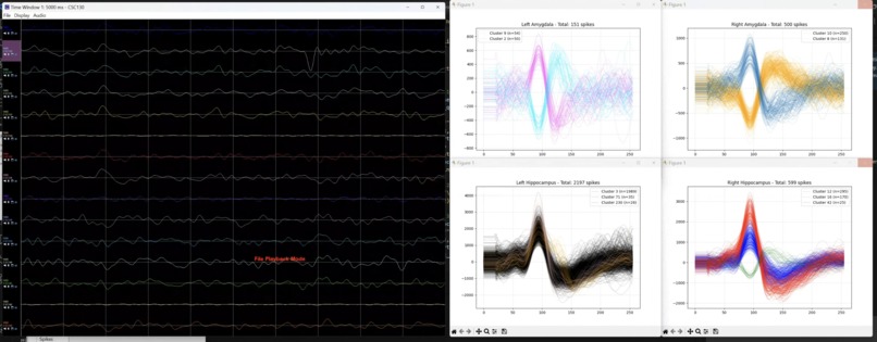 RT-Treat: Real-time neuronal analysis for epilepsy treatment – screenshot 1