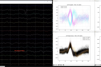 RT-Treat: Real-time neuronal analysis for epilepsy treatment