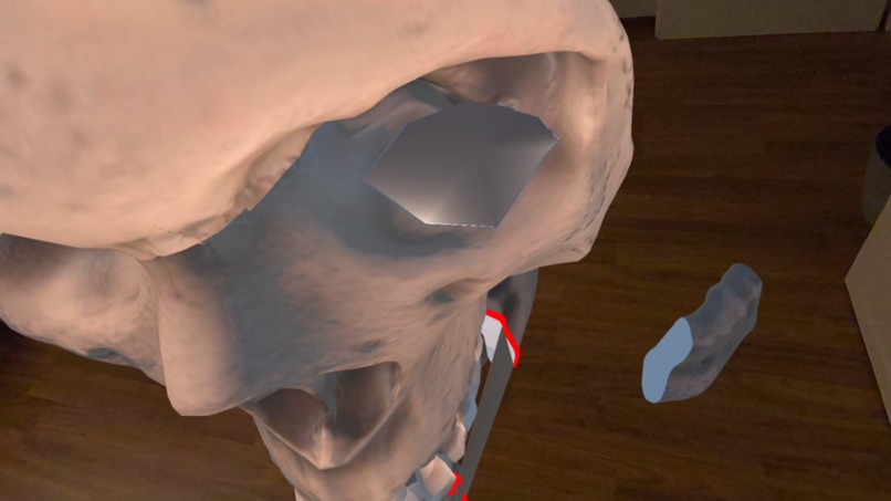 SurgiPlanXR – screenshot 3