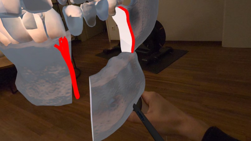 SurgiPlanXR – screenshot 5