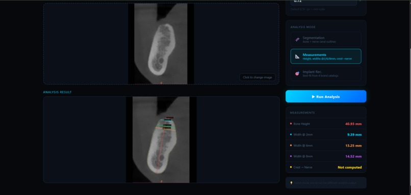 AI-Driven CBCT Implant Planning System – screenshot 5