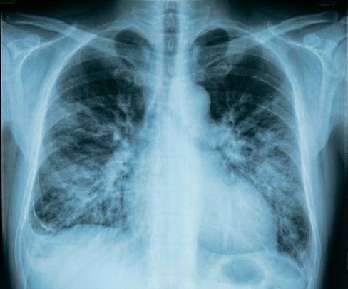 Pneumanosis – screenshot 3