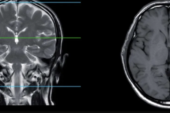 Brain Tumor Classification Model