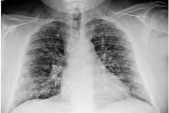 RadiAI: Explainable Chest X-Ray Diagnosis Assistant 