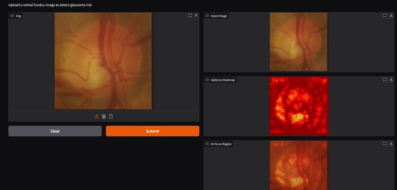 GlaucoScan XAI – screenshot 3
