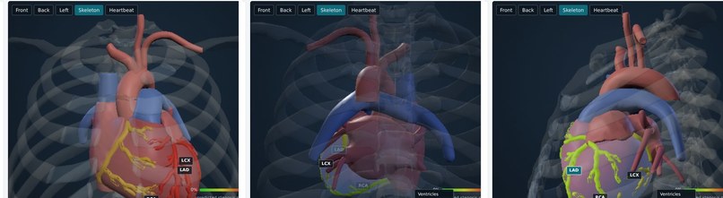 Cardio3D: Interactive 3D Coronary Risk & Stenosis Visualizer – screenshot 2