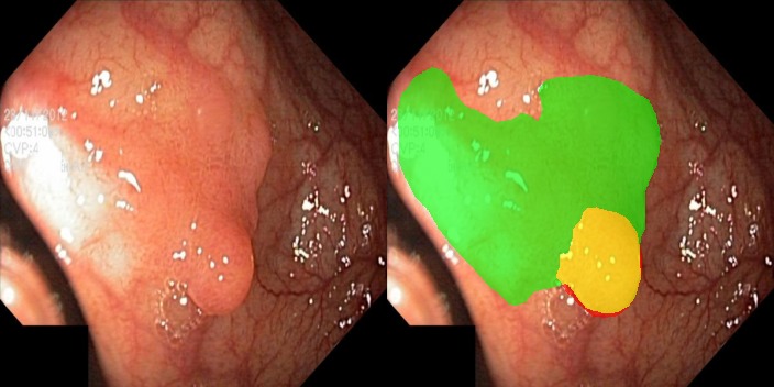 Lumen Colonoscopy AI – screenshot 2