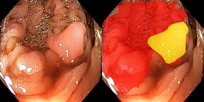 Lumen Colonoscopy AI – screenshot 3