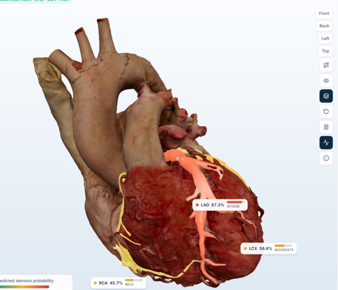 CardioVista: 3D AI Coronary Artery Disease Detection – screenshot 2