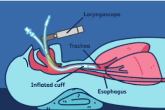 Auto-Regulating Intubation Tube Cuff Pressure System