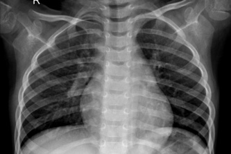 Triage Optimiser for Pneumonia Detection
