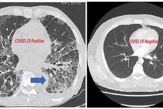Using CT Scan Images and AI for accurate detection of Covid