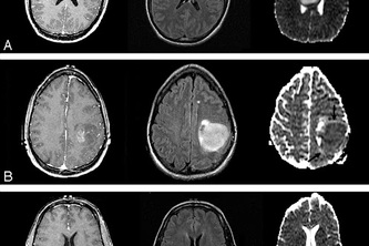Brain Tumor Detector