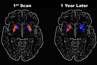 Health Care-Parkinson Disease Detection