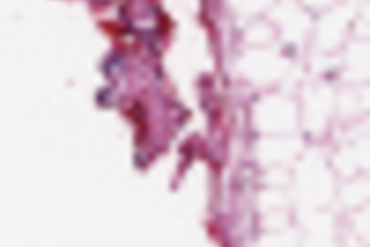 Invasive Ductile Carcinoma Classifier